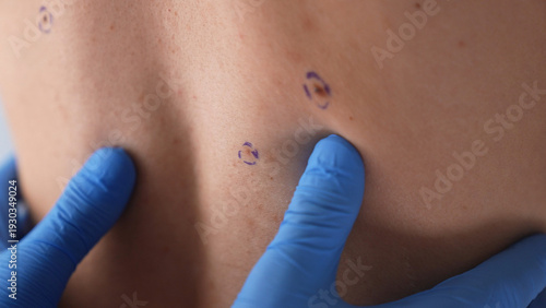 Billede på lærred Dermatologist in blue gloves examines a marked mole on a hairy male back during skin cancer screening and plastic surgery consultation