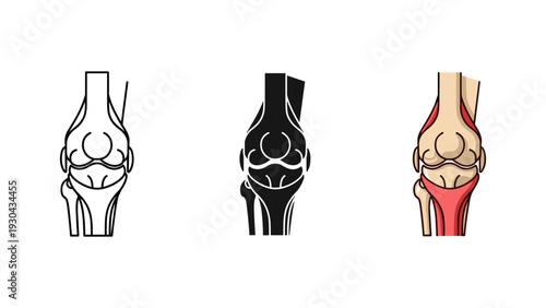 Knee joint anatomy stages illustration medical osteoarthritis progression diagram vector graphic