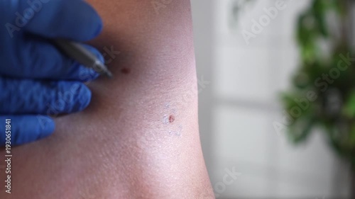 Dermatologist in blue gloves examines a mole on a hairy male torso during skin cancer screening and plastic surgery consultation.