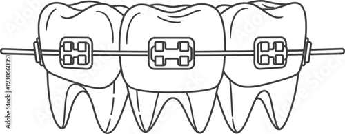 Teeth with Orthodontic Braces on Wire