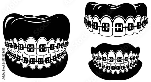 Orthodontic treatment with braces on dental models showing various stages of teeth alignment and correction process