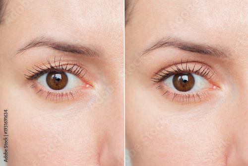 Canvastavla Comparison of young woman's eyes before and after eyelid surgery