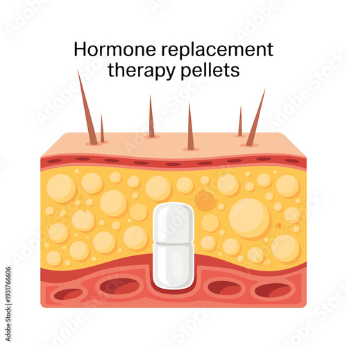 Hormone replacement therapy pellets inserted under human skin layer