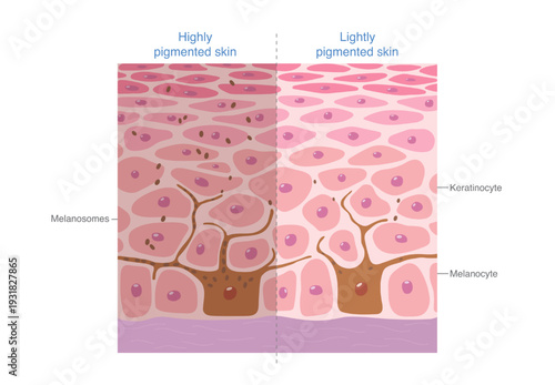Comparison of highly pigmented and lightly pigmented skin. Melanocytes transfer melanin to surrounding skin cells. Difference skin tone while similar epidermal structure. hyperpigmentation.