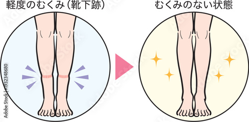 軽度のむくみ（靴下跡）からむくみのない状態への変化