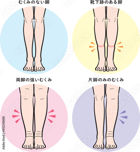 脚のむくみの種類セット