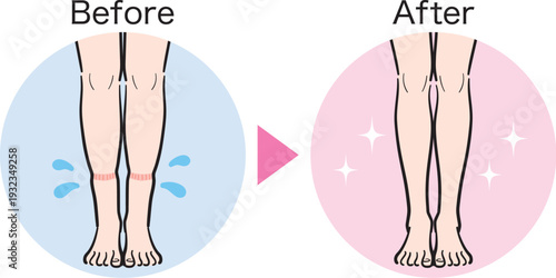 脚の軽度むくみ（靴下跡）のビフォーアフター