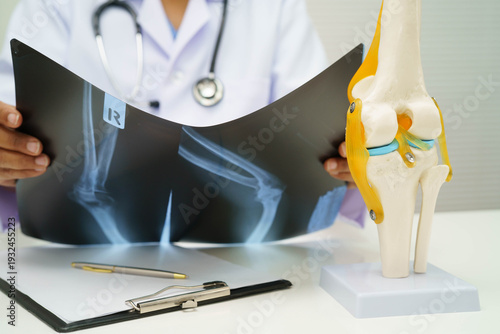 Doctor examining knee joint bone radiography xray film.