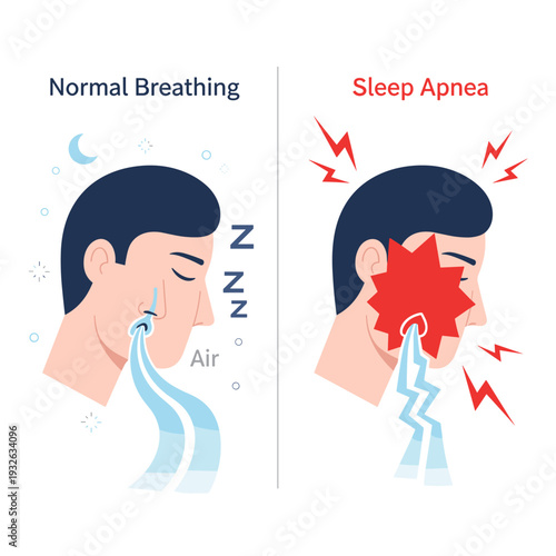 Conceptual Vector Art of Sleep Apnea Airway Blockage