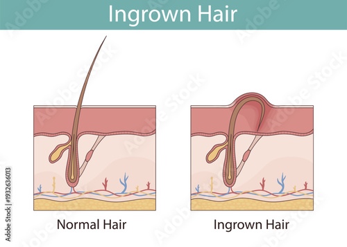 Ingrown hair, hand-drawn anatomical illustration in cartoon style