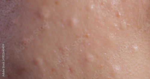 Injectable cosmetology. Facial biorevitalization procedure using a hyaluronic acid-based product. Papules on female face . close-up