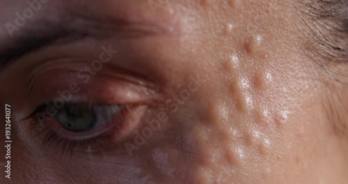 Injectable cosmetology. Facial biorevitalization procedure using a hyaluronic acid-based product. Papules on female face after biorevitalization.