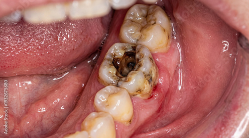 Close-up of decayed molar tooth inside mouth