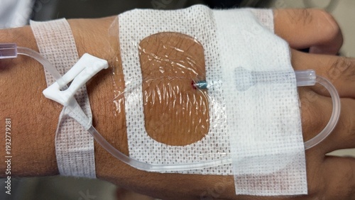 Extreme macro view of a transparent medical dressing securing an IV catheter needle on the back of a tanned human hand.