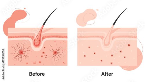 Comparison of a human skin cross section showing a hair follicle with inflammation before and after effective treatment.