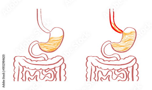 Gastroesophageal reflux pain