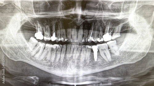 X-ray image of a dental arch, with fillings and some teeth with dental implants and root canal treatment. Brasília, Brazil, 2025