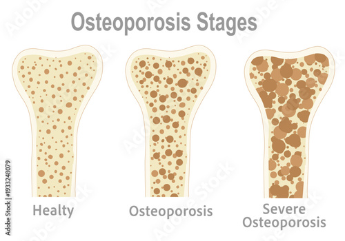 Osteoporosis stages, severe porous bone. Bone cross section, structure. Pair, normal, health, mass and pore, fragile, spongy, osteoporotic bone, anatomy diagram.  Medical illustration vector