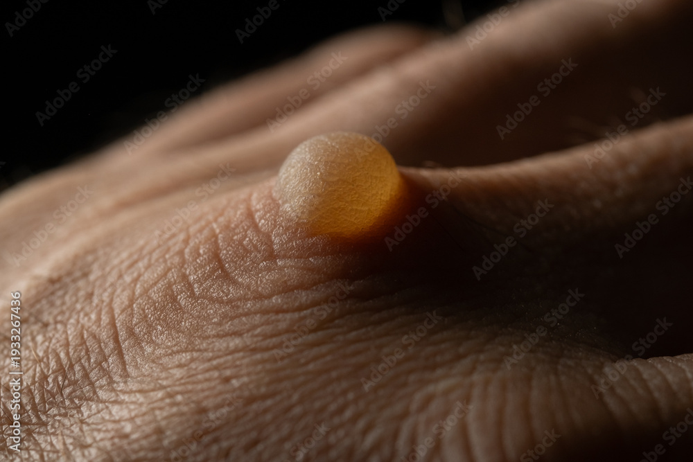 Fototapeta premium Close Up of Burn Blister on Male Hand Knuckle Black Background