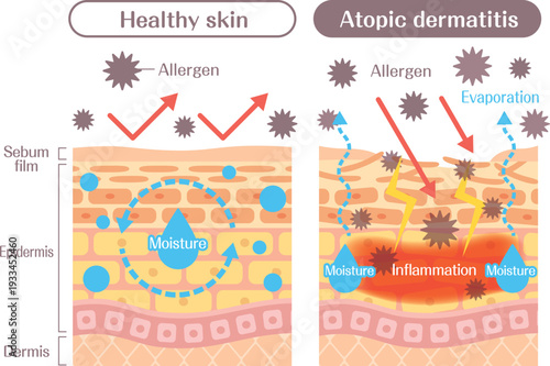 Atopic dermatitis skin structure diagram comparison