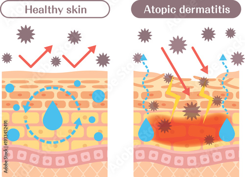 Atopic dermatitis skin structure diagram comparison