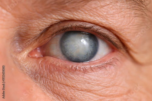 Close Up Eye with Clouded Lens Cataract Detail Photo for Ophthalmology Diagnosis Clinical Imaging and Patient Education