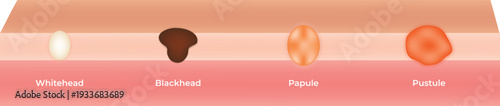 Type of Acne Diagram Vector Illustration
