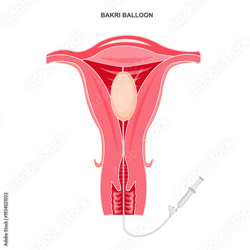 The Bakri balloon procedure is a lifesaving method to control postpartum hemorrhage by inserting a balloon into the uterus to apply pressure and stop bleeding.Medical illustration.