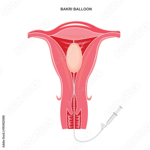 The Bakri balloon procedure is a lifesaving method to control postpartum hemorrhage by inserting a balloon into the uterus to apply pressure and stop bleeding.Medical illustration.