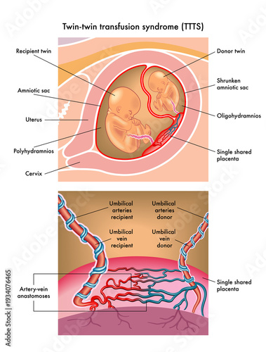 Medical illustration of Twin-twin trasnfusion syndrome (TTTS)