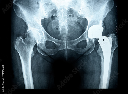 X-ray of the pelvis Endoprosthesis, the socket of the hip joint rheumatic diseases and Rheumatoid Arthritis