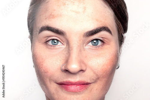 Tableau sur toile Pigment spots on a woman's face