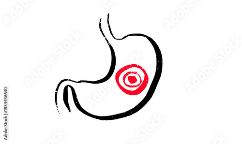 Gastroesophageal reflux pain