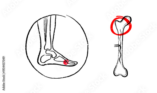 Osteomyelitis disease sketch