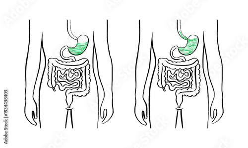 Gastroesophageal reflux pain