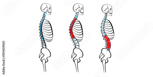 Scoliosis spine deformity