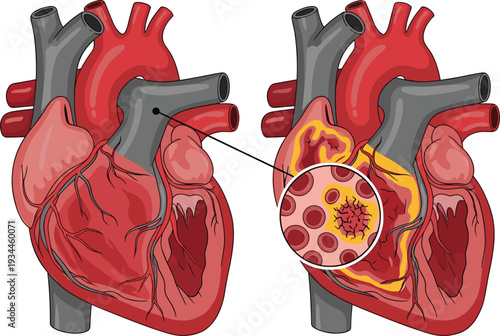 Human heart anatomy with artery blockage medical vector illustration