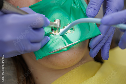 Fotografía Dentist drilling tooth under rubber dam during dental treatment