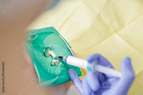 Billede på lærred Dentist applying composite resin under rubber dam isolation
