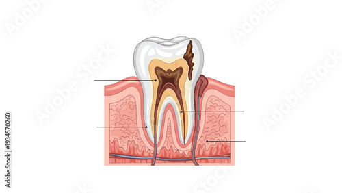 Detailed medical illustration showing the cross section of a human tooth with significant enamel decay and gum inflammation.
