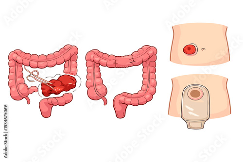 Medical illustration showing details of intestines and colostomy