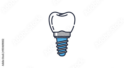 Dental Implant Illustration Demonstrating Modern Medical Procedures For Tooth Replacement
