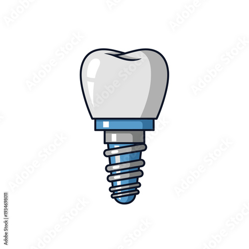 Dental Implant Illustration Demonstrating Modern Tooth Replacement Procedures For Educational