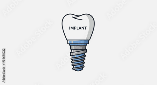 Dental Implant Illustration Demonstrating Tooth Replacement Procedure with White Background