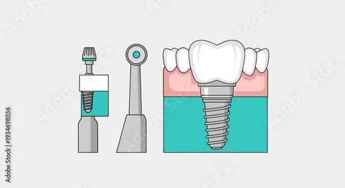 Dental Implant Illustration Demonstrating Tooth Replacement Procedure And Tools
