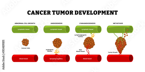 Stages of cancer tumor development stages process. Cancer cell invasion. Tumor growth. From abnormal cell growth, angiogenesis, lymphangiogenesis, metastasis. Blood vessel and lymphatic vessel