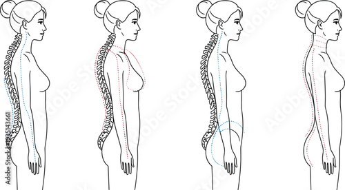 Illustration of a Woman's Posture with Spinal Alignment, Highlighting Correct and Incorrect Body Positions for Health and Wellness Education