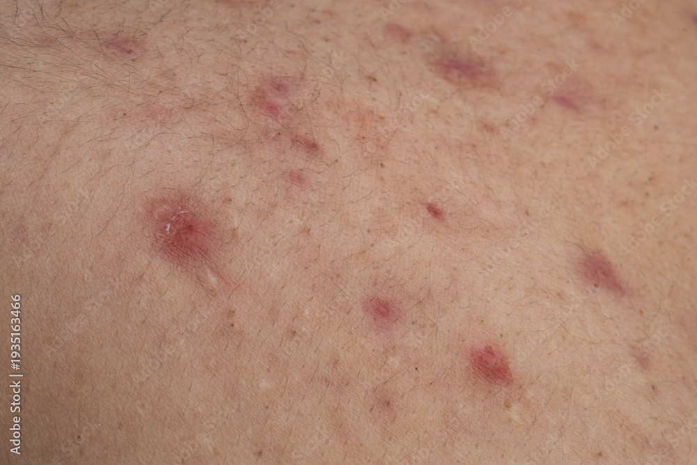 Fototapeta premium Acne and pimple,on skin closeup. Acne macro, pimple on skin. Pimple texture in pores. Pimple macro for dermatology.