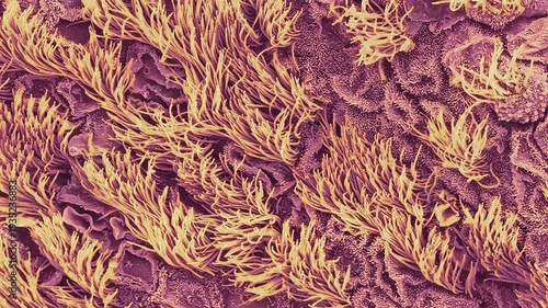 Uterine cancer, SEM
