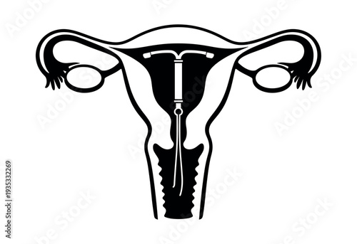Uterus with an intrauterine device (IUD) for birth control, representing female reproductive system anatomy and medicine